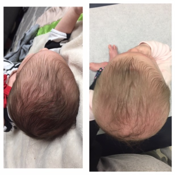 Metopic Synostosis Before and After Surgery