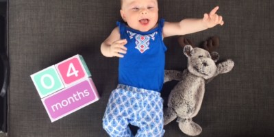 Metopic Synostosis Baby